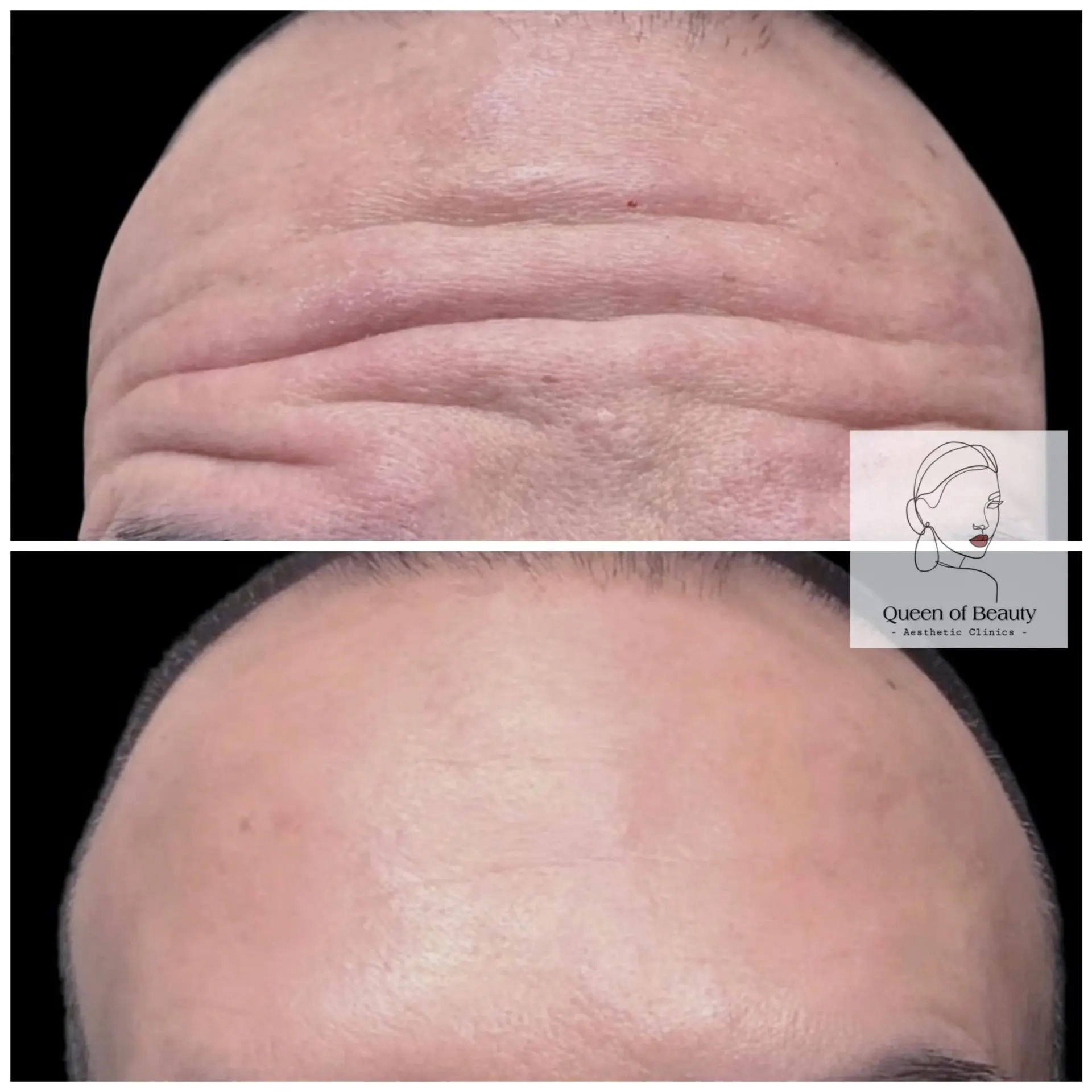 queen-of-beauty-anti-wrinkle-injections-min