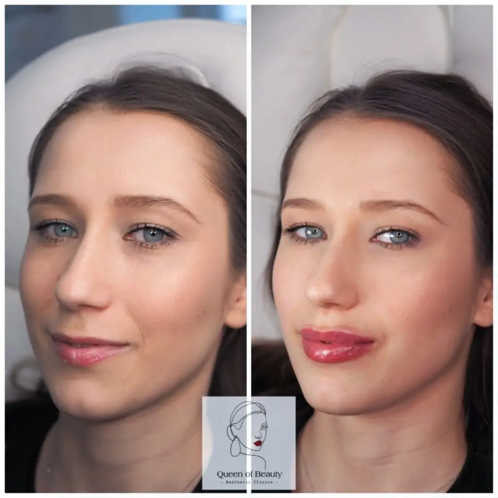 queen-of-beauty-how-much-are-lip-fillers