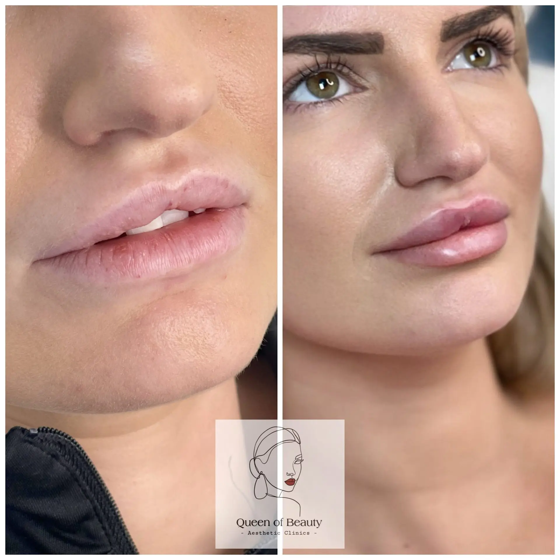 queen-of-beauty-juvederm-filler