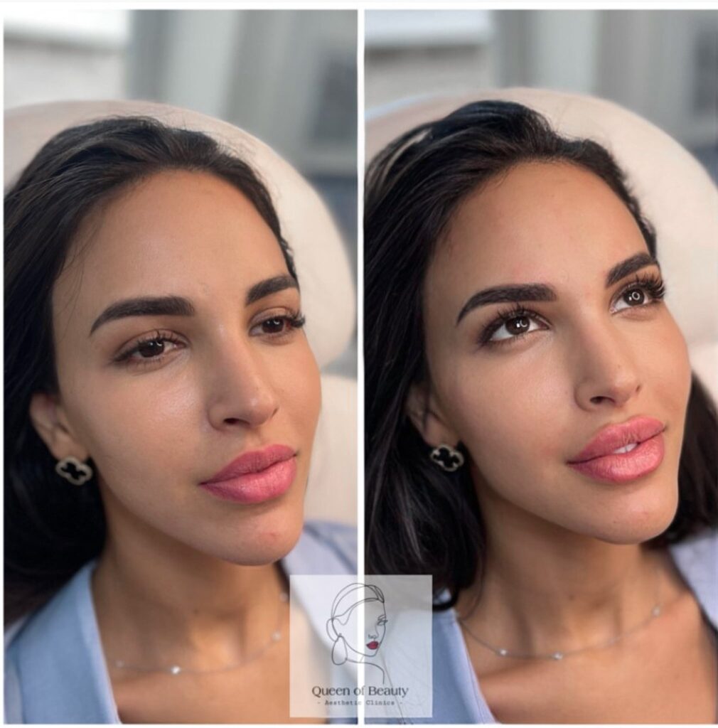 queen-of-beauty-lip-filler-before-and-after