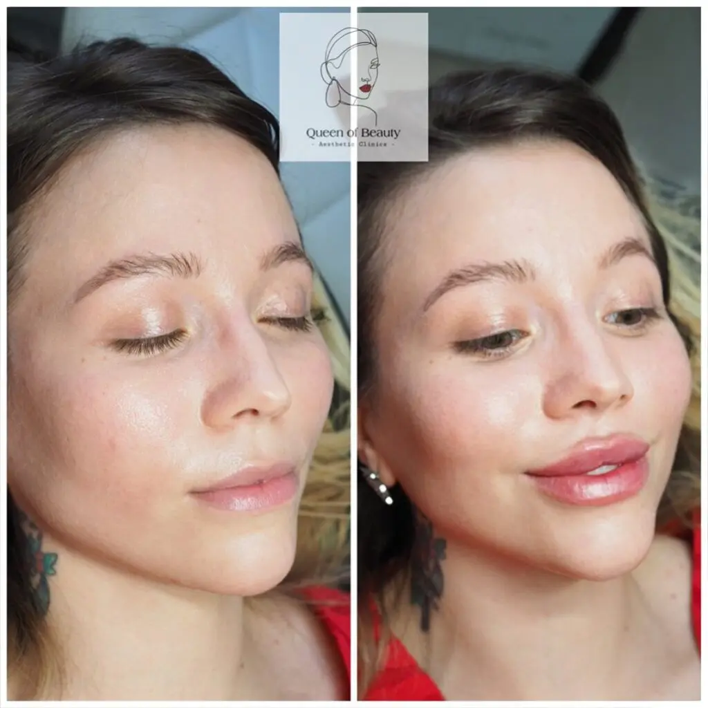 queen_of_beauty_lip_augmentation_cost