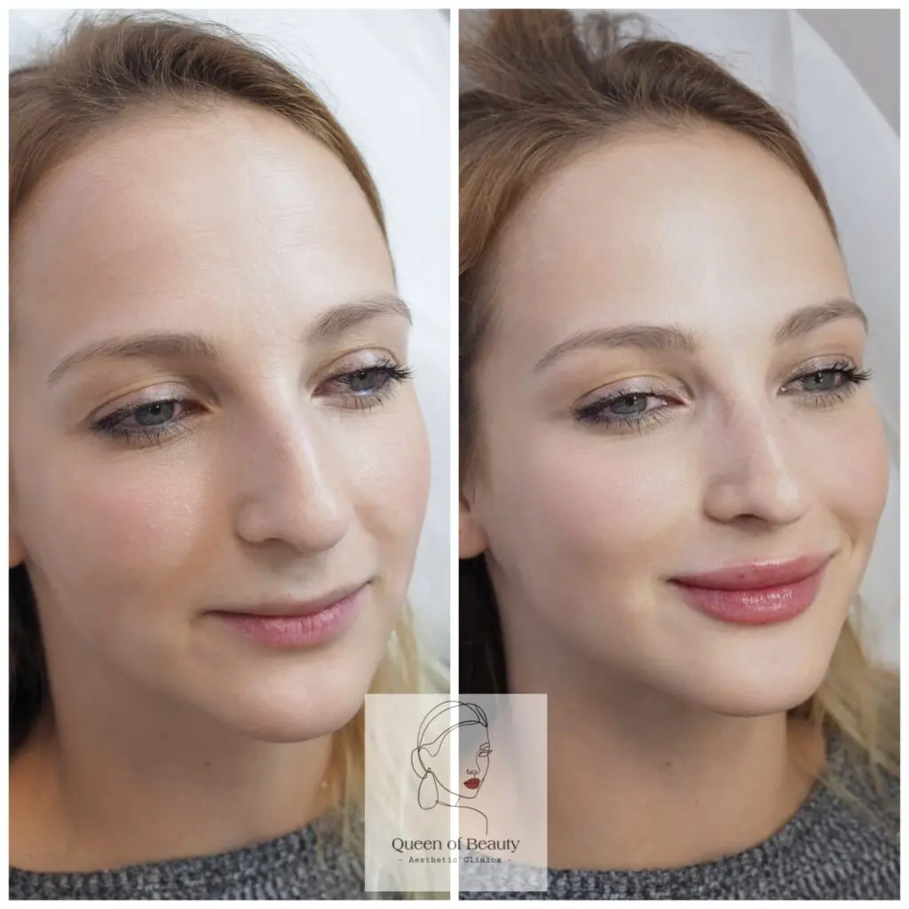 queen_of_beauty_lip_augmentation_filler