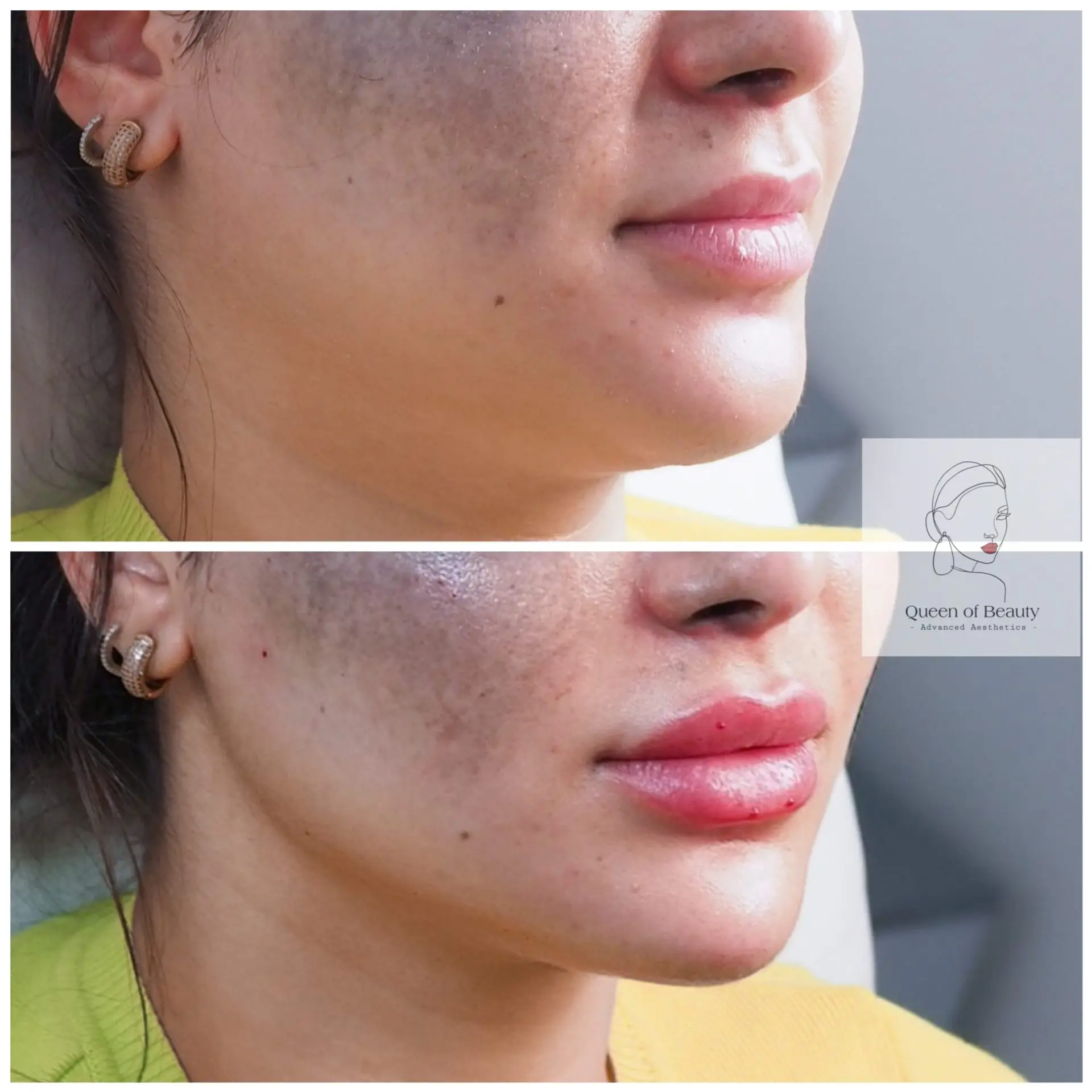 queen_of_beauty_lip_augmentation_london