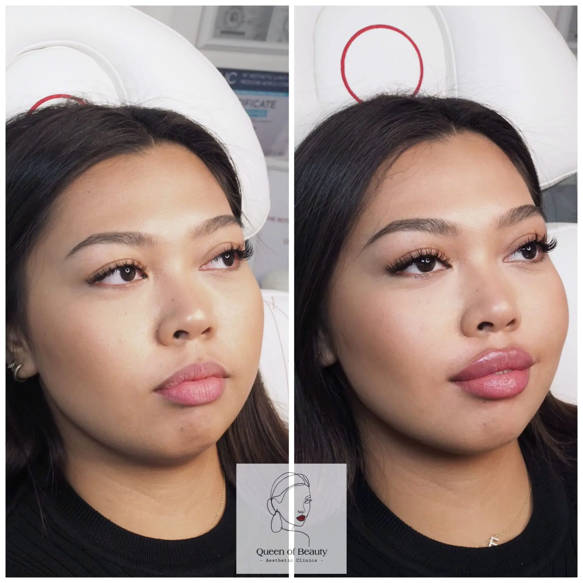 queen_of_beauty_lip_augmentation_near_me