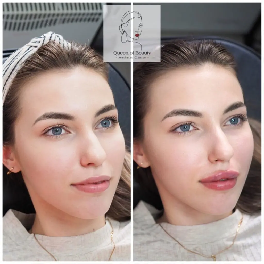 queen_of_beauty_lip_augmentation_price