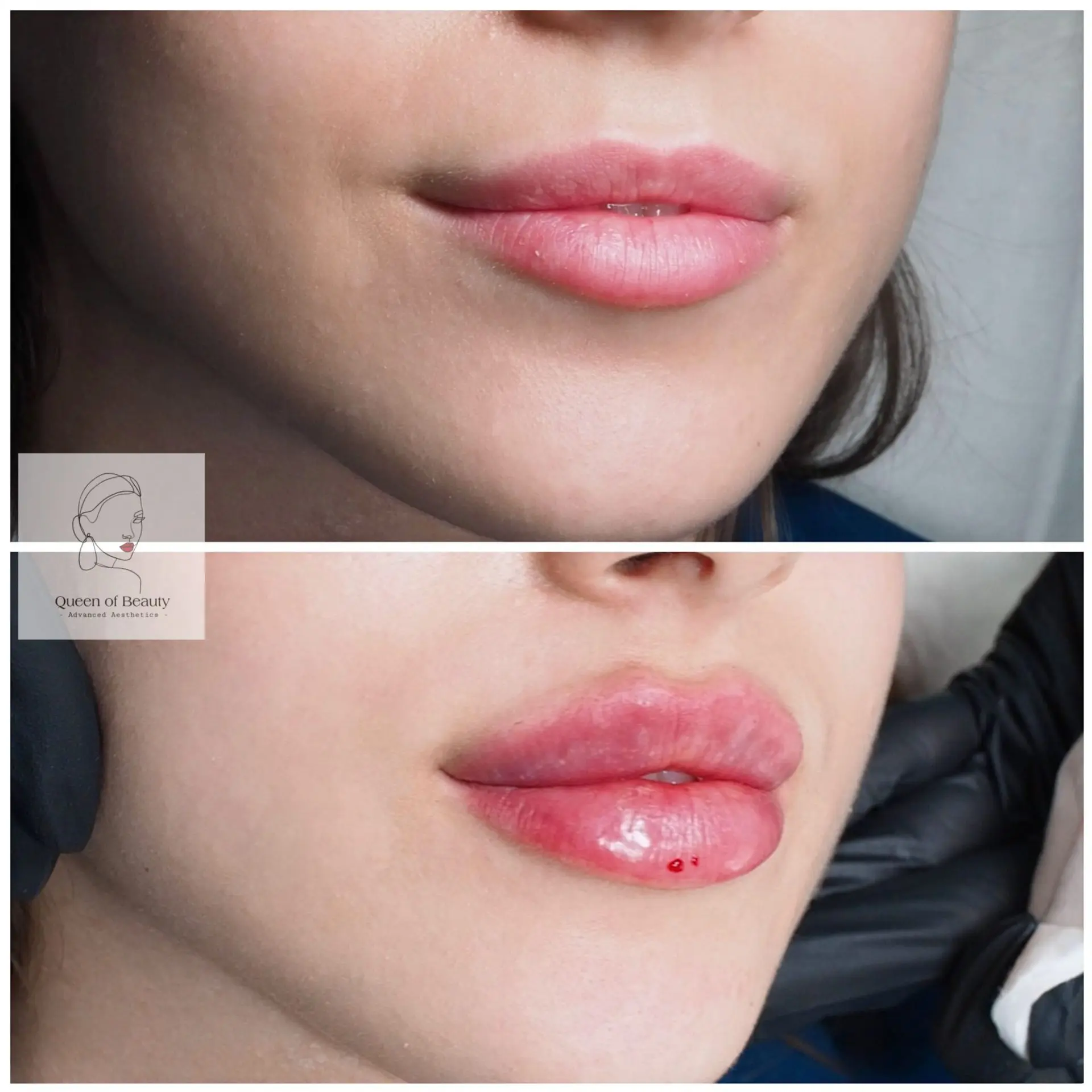 queen_of_beauty_lip_enhancement