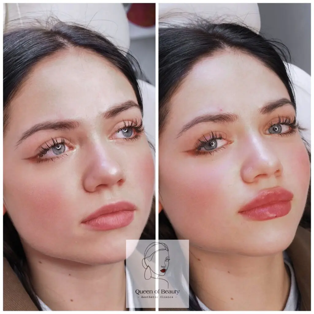 queen_of_beauty_lip_fillers_london