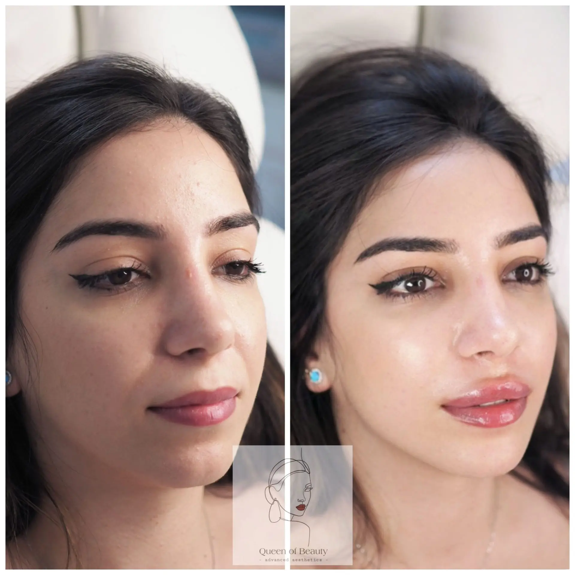 queen_of_beauty_lip_fillers_london
