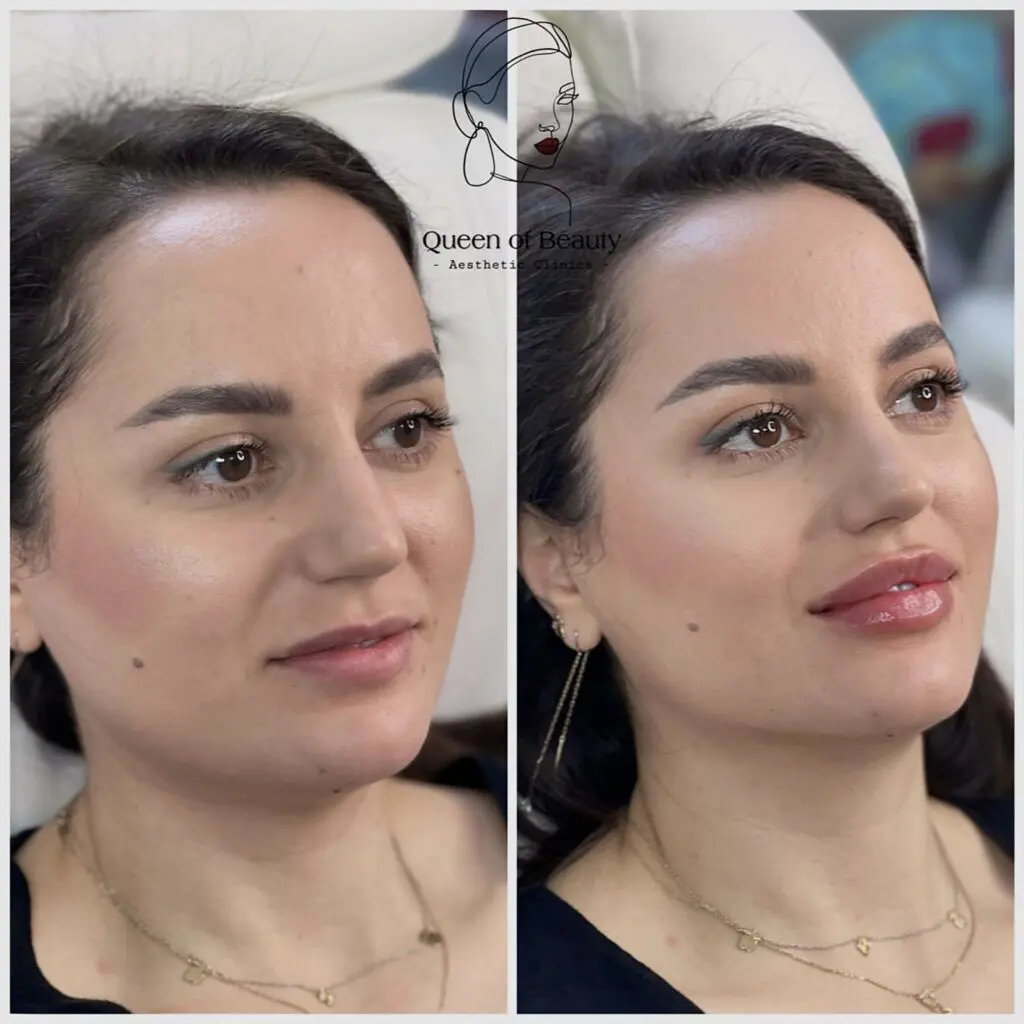 queen_of_beauty_lip_fillers_near_me
