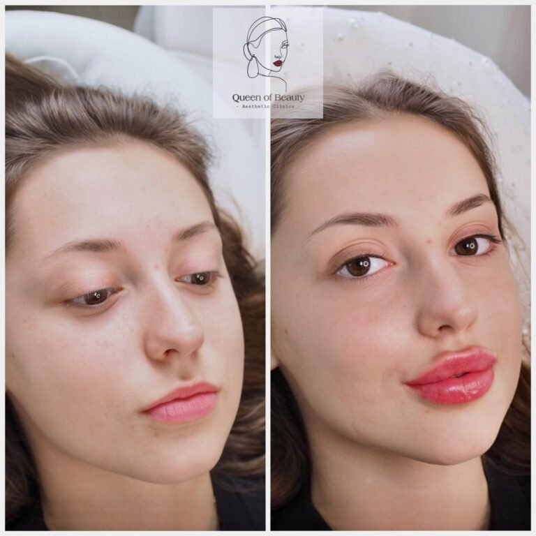 queen-of-beauty-lip-filler