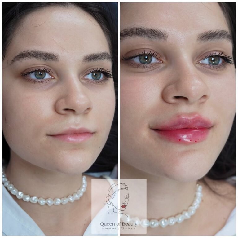 queen_of_beauty_lip_augmentation